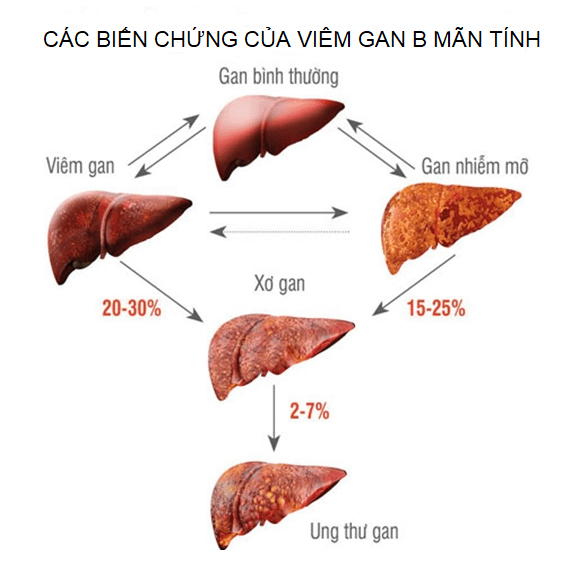 Lý giải: Viêm gan B mãn tính có chữa được không?