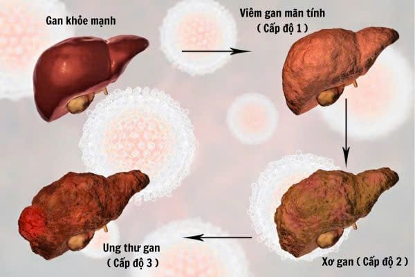Dấu hiệu nhận biết gan nhiễm mỡ thường gặp