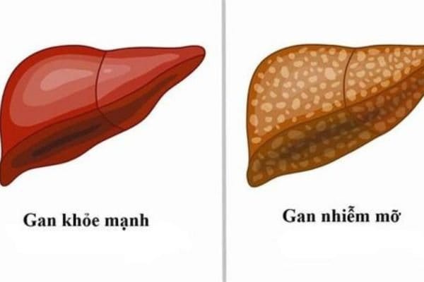 Khi-bi-gan-nhiem-mo-do-3-thi-luong-mo-chiem-toi-66_-trong-luong-gan