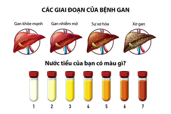 xet-nghiem-nuoc-tieu-phat-hien-dau-hieu-gan-nhiem-mo
