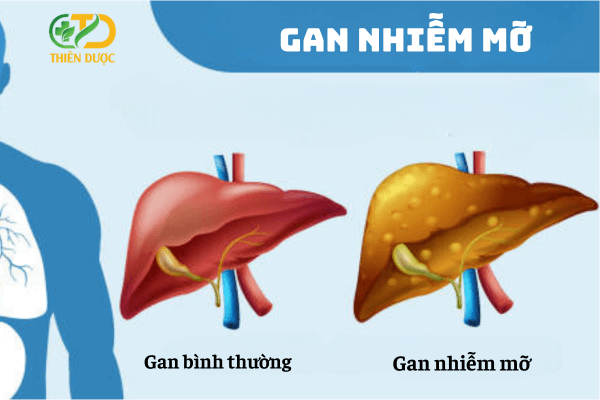 gan-nhiem-mo-la-gi